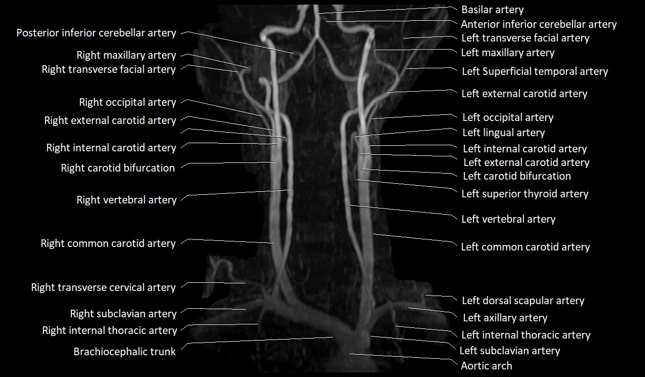 MRA neck carotid arteries labeled anatomy image MIP 3D image 6.webp